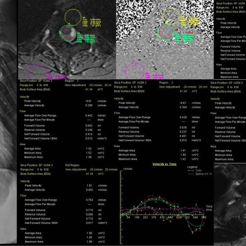 Cerebrospinal fluid velocity changes of idiopathic scoliosis: A preliminary study on 3-tesla PC-MRI and 3D-SPACE-VFAM data